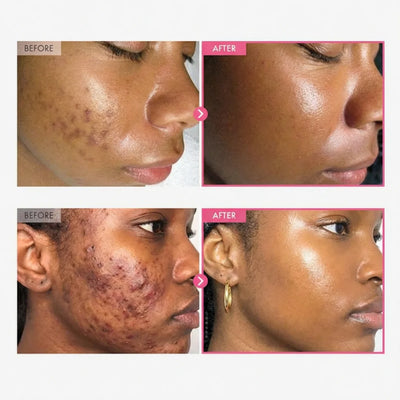 Alpha Arbutin + TXA Cream